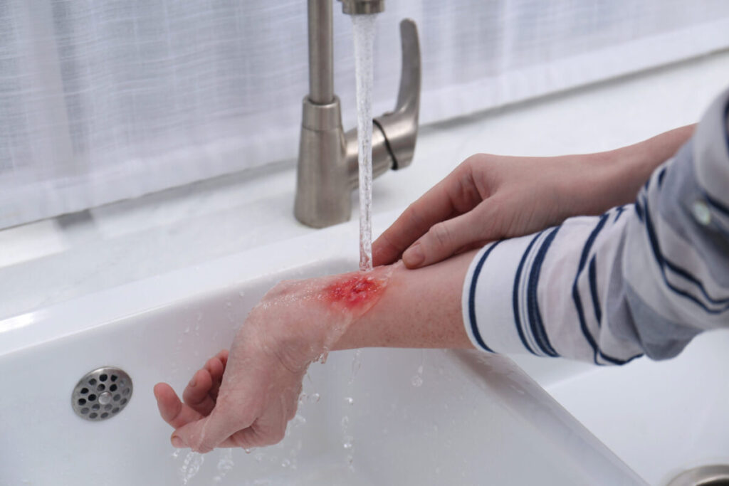 Need help after a serious kitchen burn?