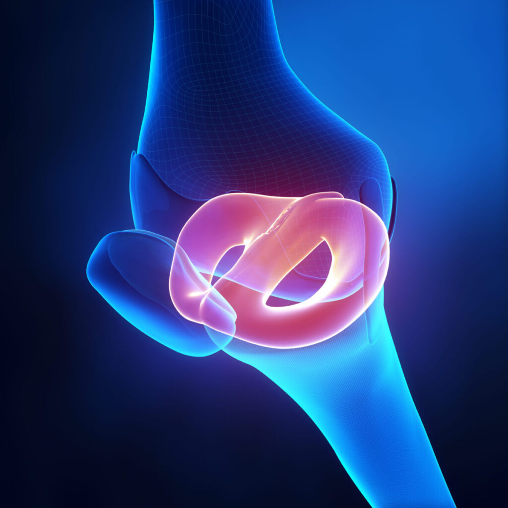 Understanding Meniscus Tears in Healthcare Workers